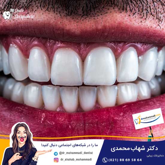مراحل کامپوزیت دندان را در کدام فیلم کامپوزیت دندان به طور کامل ببینیم؟ - کلینیک دندانپزشکی دکتر شهاب محمدی